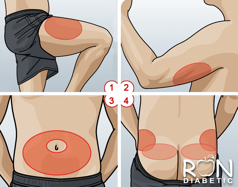 Места инъекций инсулина: куда делать уколы инсулина чтобы не образовывались шишки