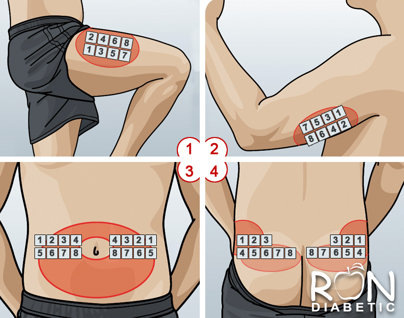 Чтобы не образовывались шишки чередуйте места инъекций инсулина