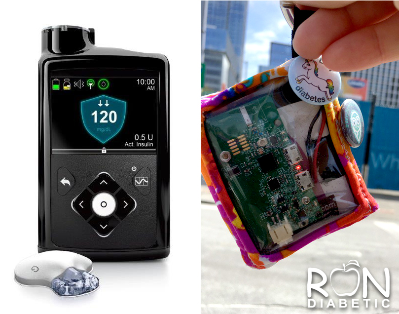 Искусственная поджелудочная железа уже для многих реальность