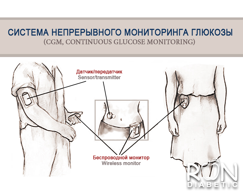 Система непрерывного мониторинга глюкозы CGM, Continuous Glucose Monitoring